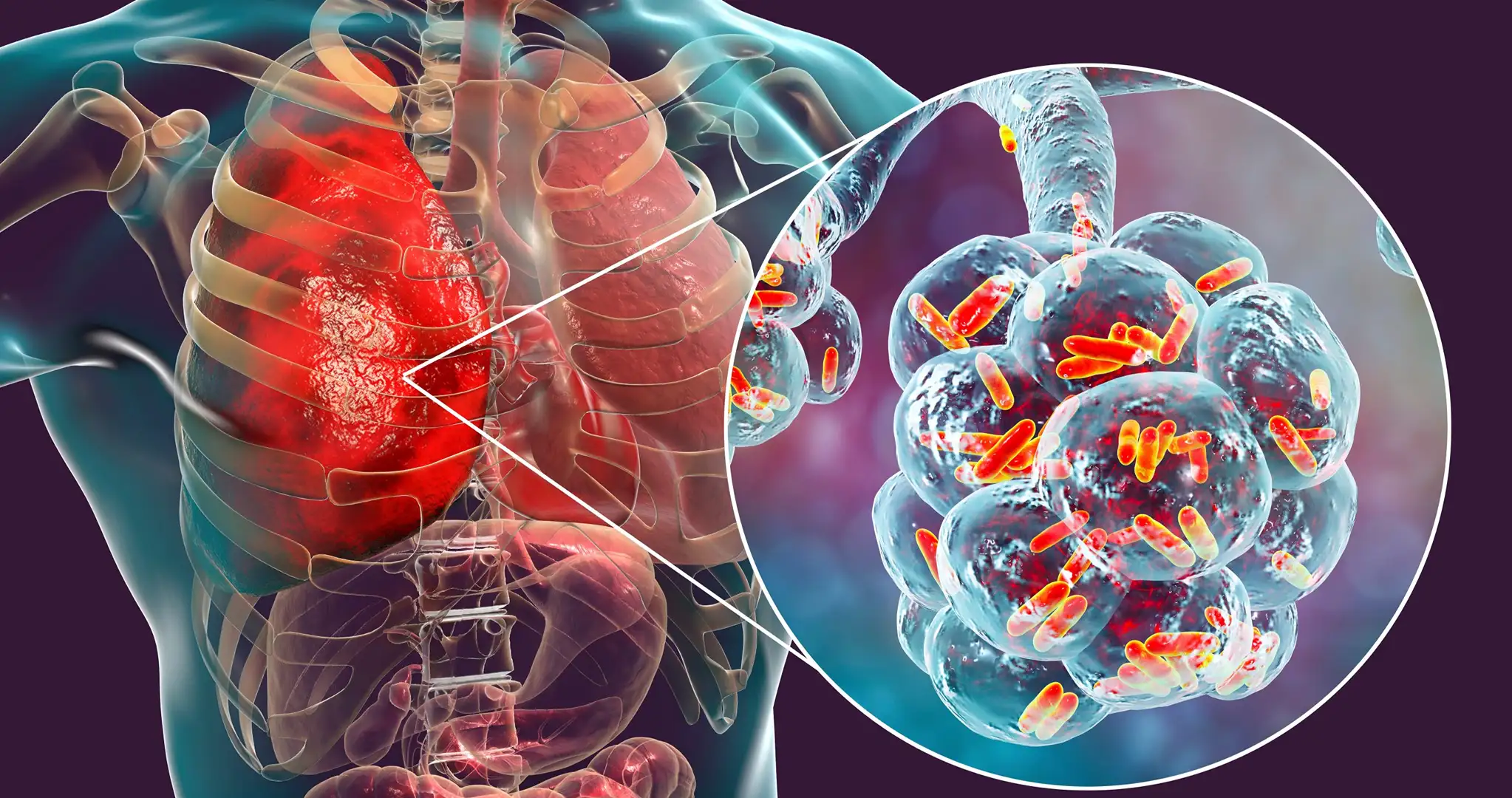 Lung Infection Treatment