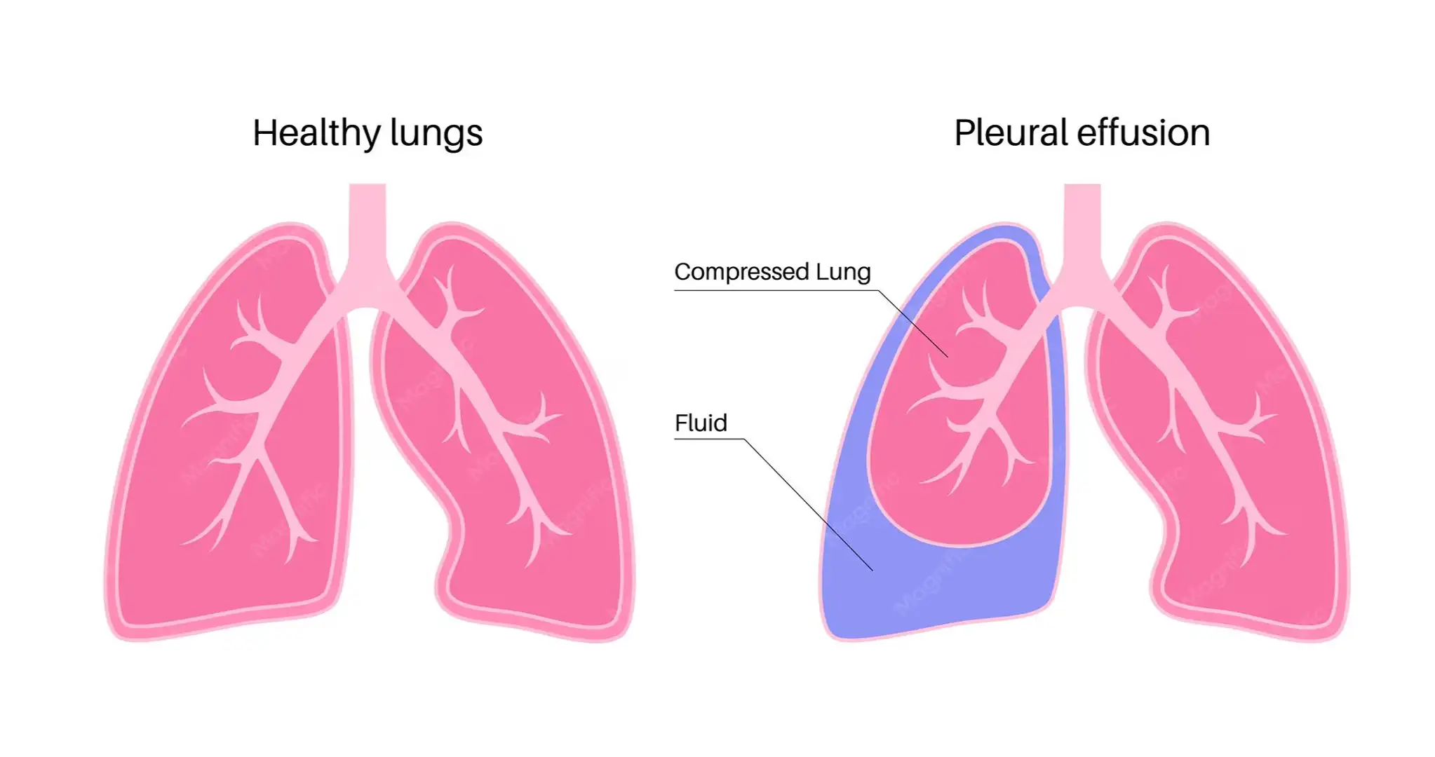 Pleural Disease Treatment